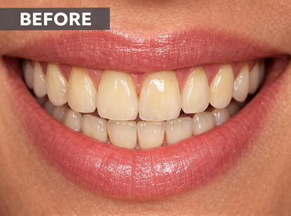 Ultimate Teeth Whitening Bundle